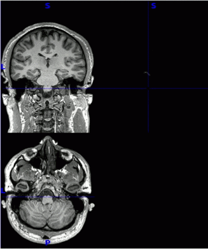 a black and white image of a person 's brain with the letter s on it