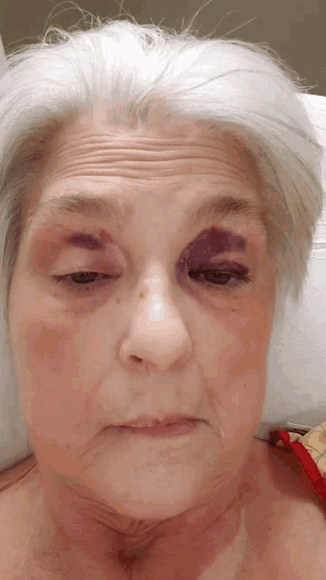 a woman with a purple eye is laying in a bed