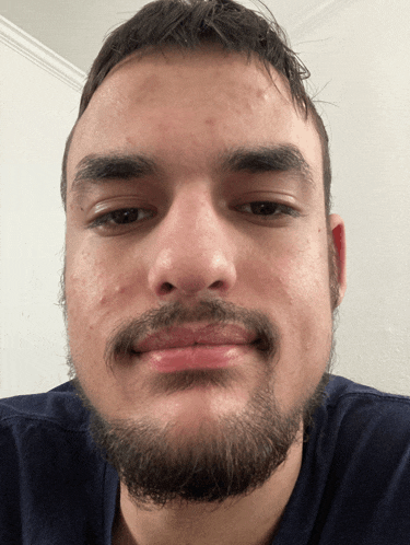 a man with a beard and acne on his face looks at the camera