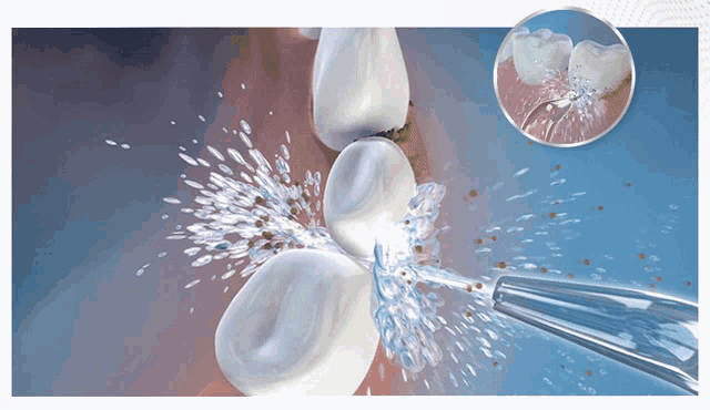 an illustration of a person 's teeth being cleaned with a water jet