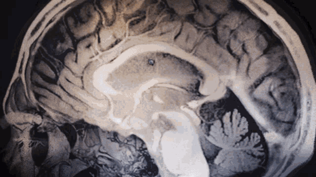 a black and white image of a brain with a few spots of light on it