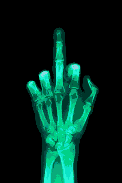 an x-ray of a hand shows the middle finger