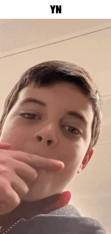 a young boy with a black eye is making a funny face with his finger .