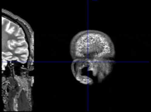 a black and white image of a brain with a blue grid