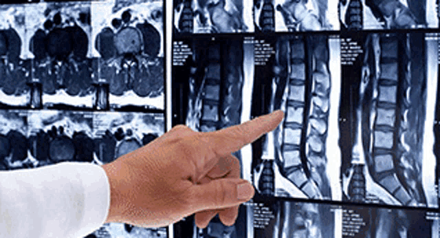 a person is pointing at an x-ray of their spine