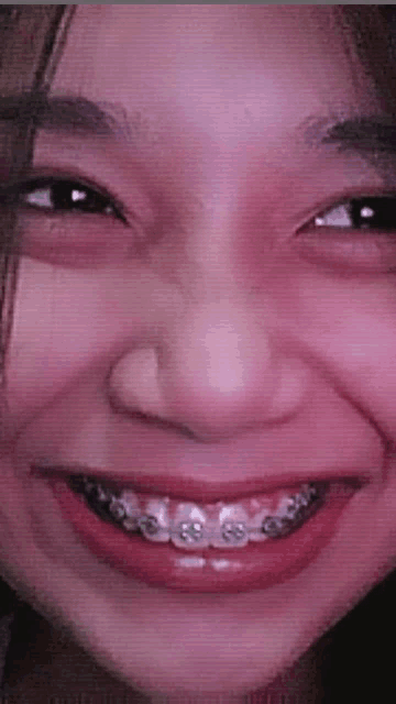 a close up of a person 's face with braces on it .