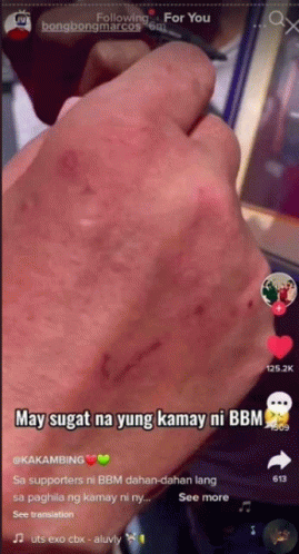Bbm Wounded Right Hand Bbm Sugat GIF - Bbm Wounded Right Hand Bbm Sugat GIFs