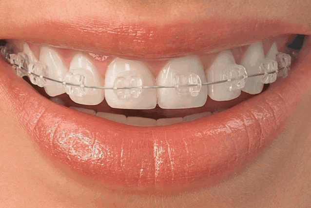 a close up of a person 's teeth with clear braces on them
