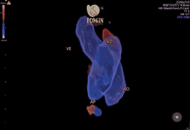 an ultrasound of a heart with the word ecogin on the bottom
