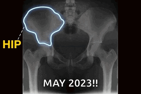 an x-ray of a person 's pelvis with a light coming out of it and the words `` may 2023 '' .