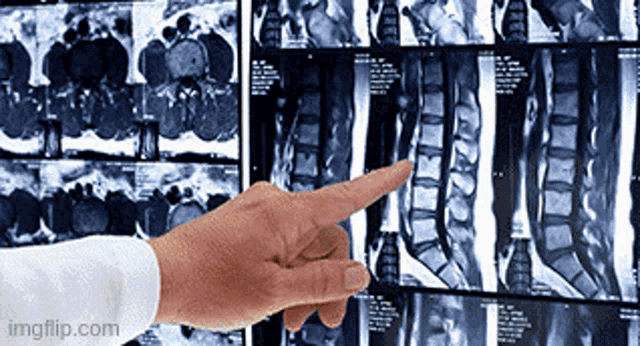 a hand pointing at a x-ray of a spine with imgflip.com in the corner