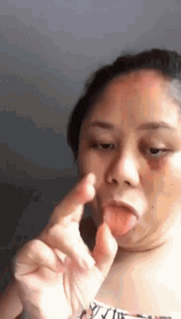 a woman with a black eye is sticking out her tongue .