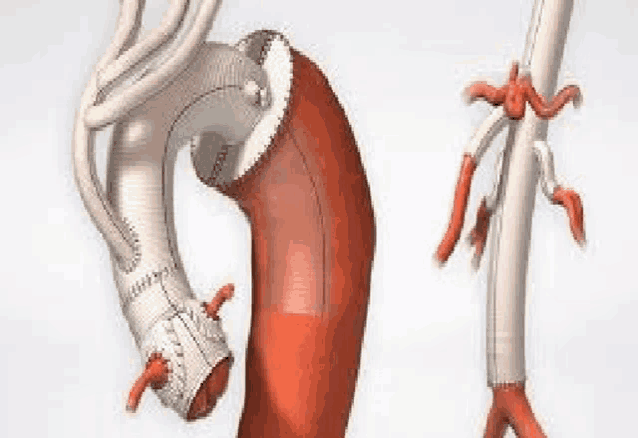 a computer generated image of a blood vessel with a surgical procedure being performed on it .