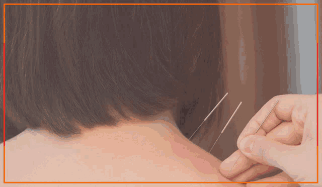 an ad for acupuncture treatment in toronto shows a person getting acupuncture