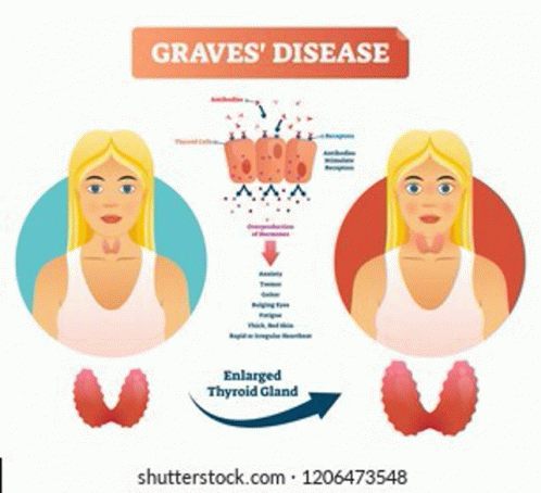 Canada Graves Disease Market GIF - Canada Graves Disease Market GIFs