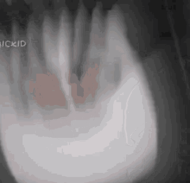 an x-ray of a person 's teeth is displayed on a screen