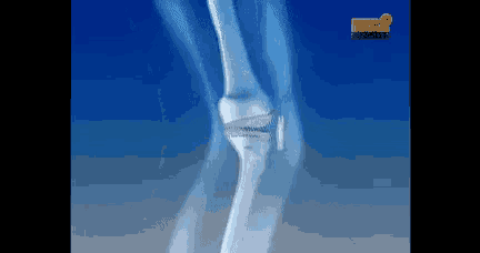 an x-ray of a person 's knee with a blue background .