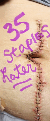 a close up of a person 's stomach with the words 35 staples later written in purple