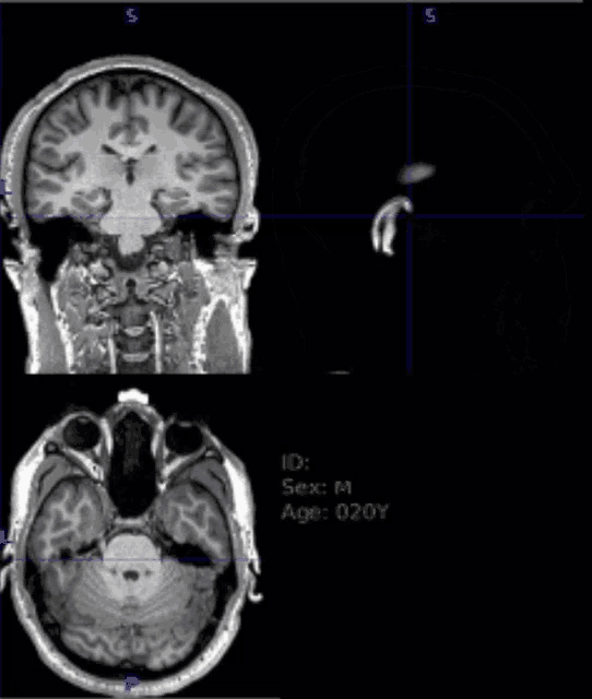 Mri Human Brain GIF - Mri Human Brain Life GIFs