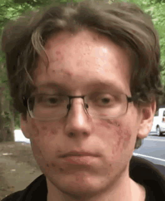 a man with glasses and acne on his face is looking at the camera .