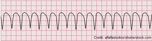a graph of a heartbeat on a piece of graph paper ..